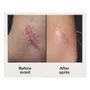 Scar Treatment