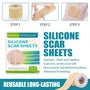 Silicone Scar Sheet Tape